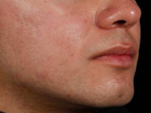 AviClear Aknebehandlung mit Laser - Bild 6 Monate nach der 3. Behandlung