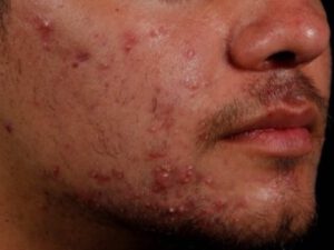AviClear Aknebehandlung mit Laser - Bild vor der Behandlung